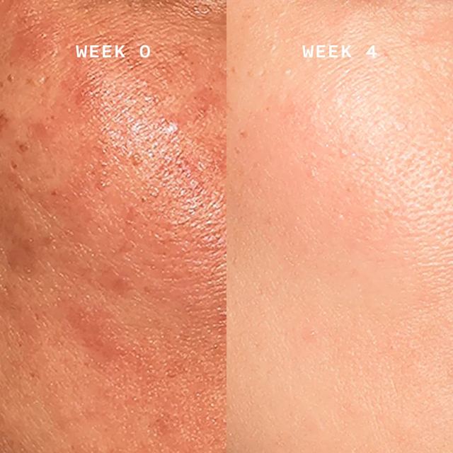 Cheek with dark spots, week 0 and week 4