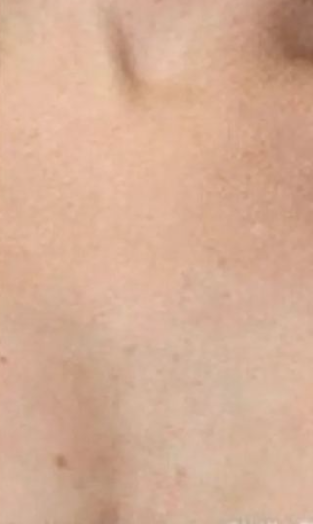 Chest at week 4 with the ageless lens: fewer sun freckles, more even tone