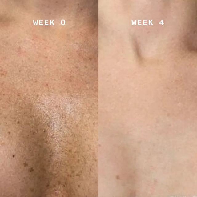 Chest with sun freckling, week 0 and week 4