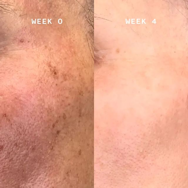 Uneven tone, week 0 and week 4